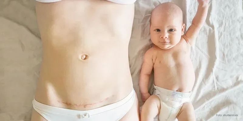 O que é parto de Hollywood?