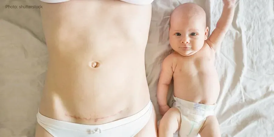 Tummy tuck after pregnancy