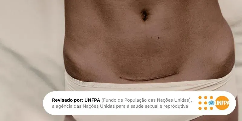 Você não é menos mãe por fazer uma cesariana