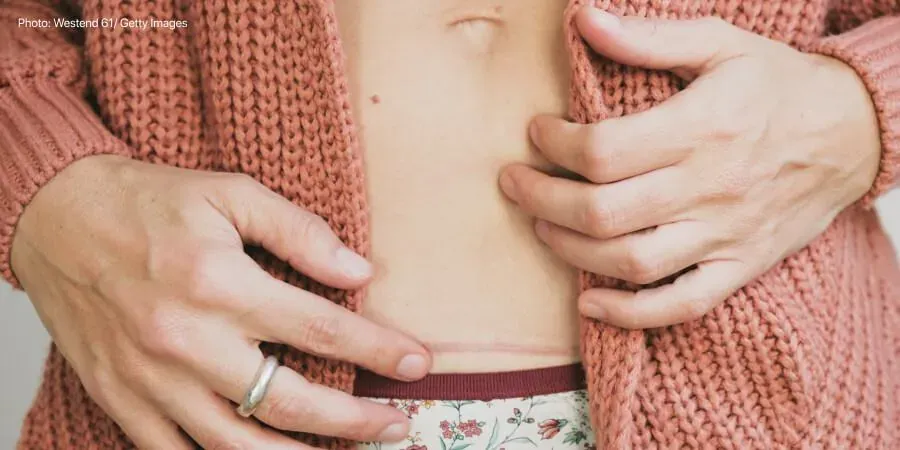 C-sections: What you need to know