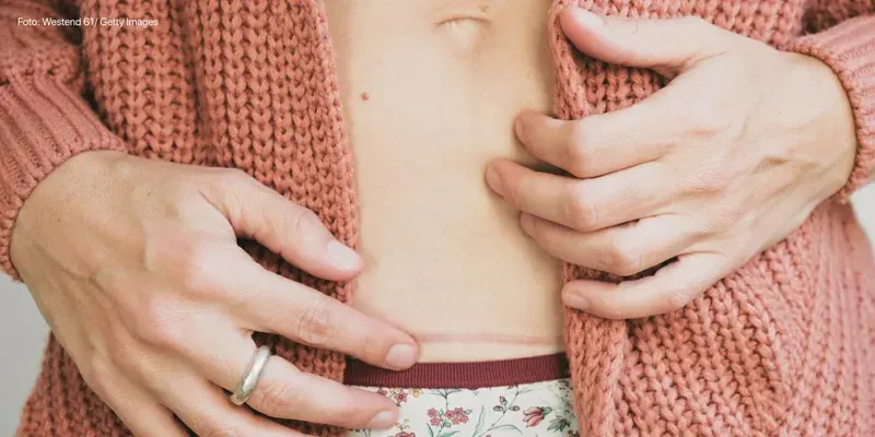 Cesáreas: o que você precisa saber